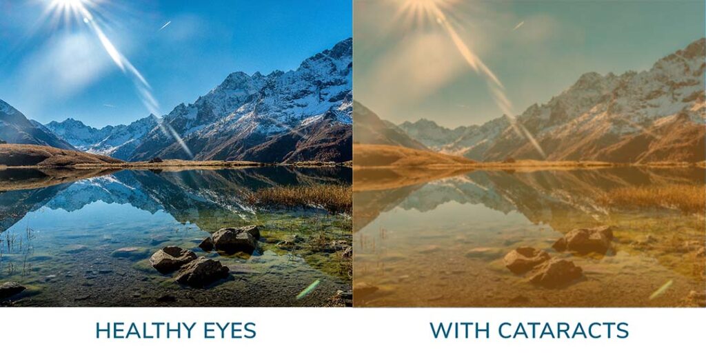 view comparison of cataract yellowed vision vs normal vision